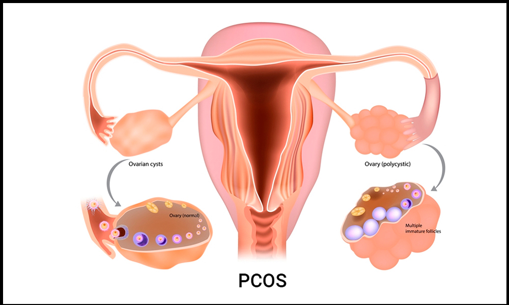 PCOD/PCOS 