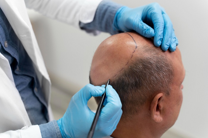 HAIR TRANSPLANT BY EXPERT HANDS